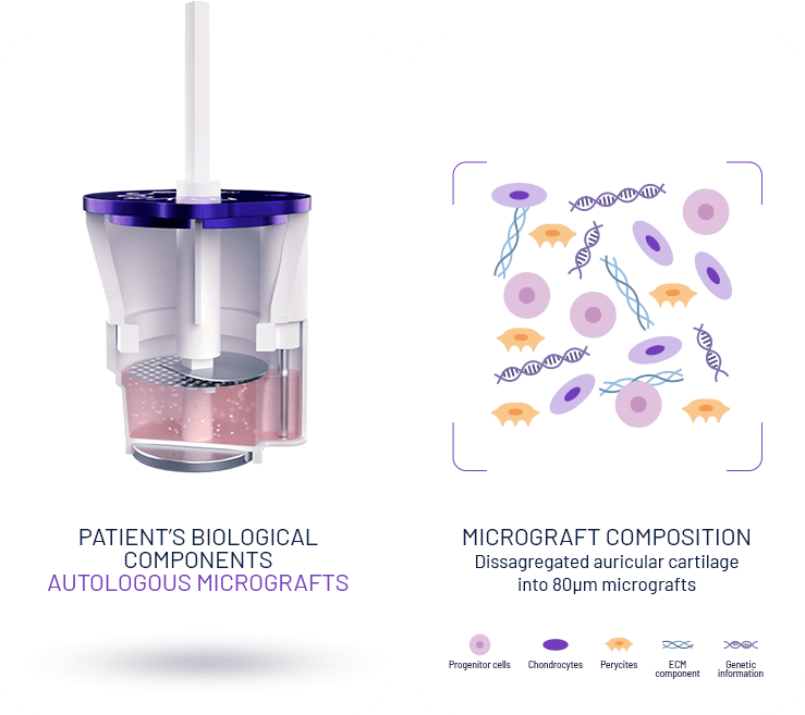 Cutaway of the single-use cartridge holding the patient’s cartilage sample, beside a key to the micrograft composition: progenitor cells, chondrocytes, pericytes, extracellular-matrix components and genetic material