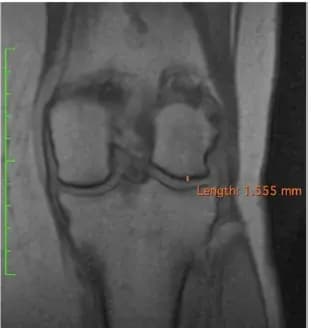 Knee MRI, front view, three years after treatment