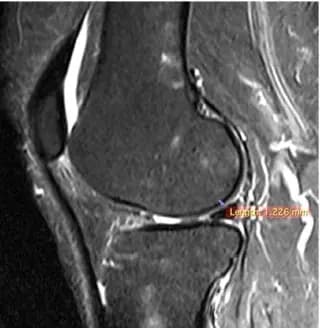 Sagittal knee MRI at follow-up from supplied study material