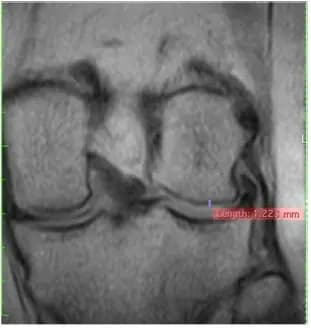 Coronal knee MRI at baseline from supplied study material