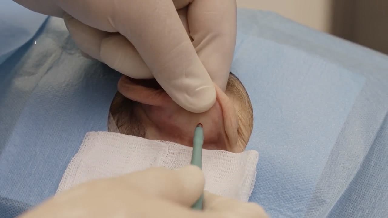 A clinician taking the auricular cartilage sample with a dermal punch